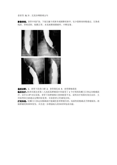 贲门癌案例1