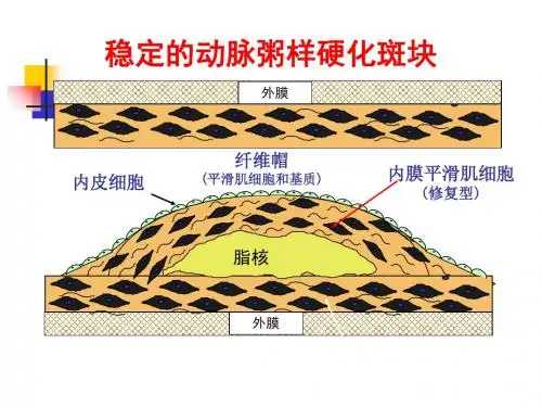 动脉硬化心脏病-PPT课件