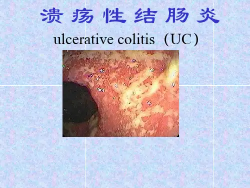 (精品) 溃疡性结肠炎课件
