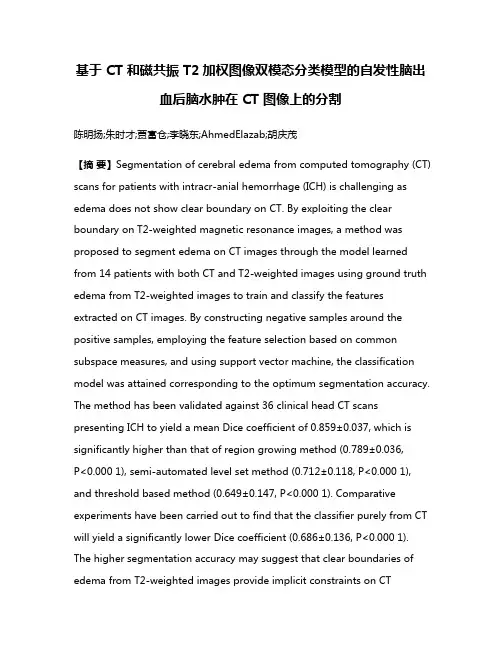 基于 CT 和磁共振 T2加权图像双模态分类模型的自发性脑出血后脑水肿在 CT 图像上的分割
