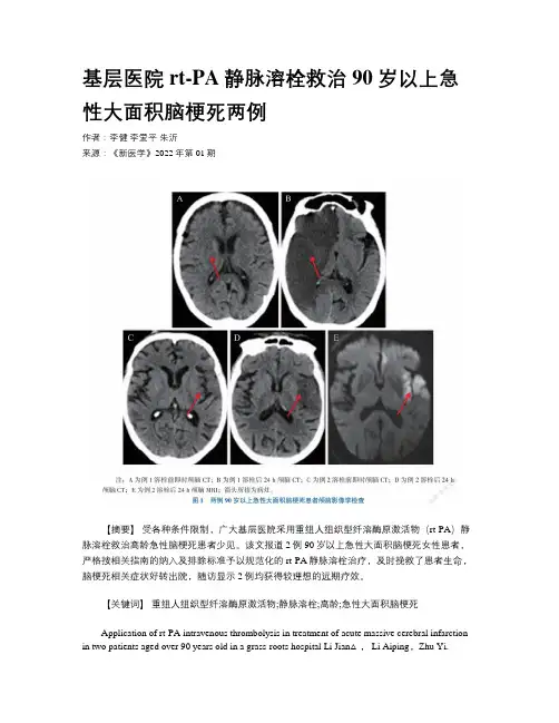 基层医院rt-PA静脉溶栓救治90岁以上急性大面积脑梗死两例