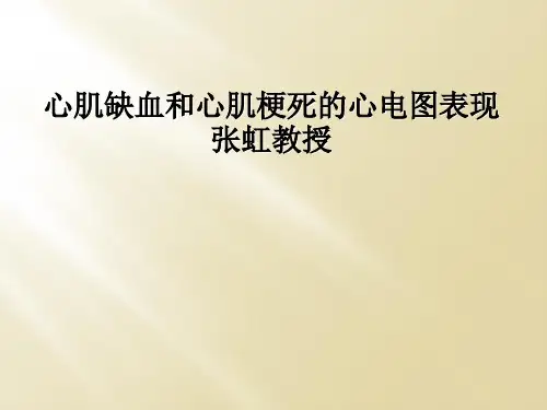 心肌缺血和心肌梗死的心电图表现张虹教授