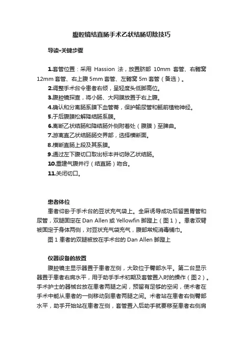腹腔镜结直肠手术乙状结肠切除技巧