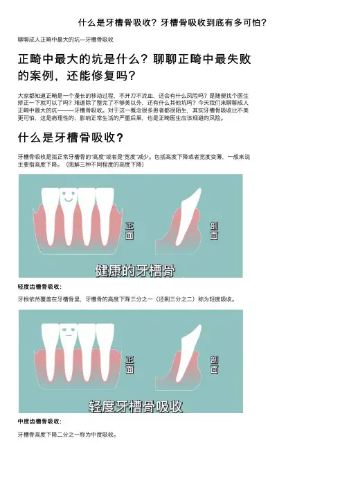 什么是牙槽骨吸收？牙槽骨吸收到底有多可怕？