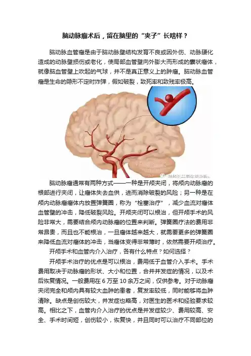 脑动脉瘤术后，留在脑里的“夹子”长啥样？