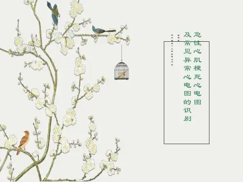 急性心肌梗死及常见心电图识别