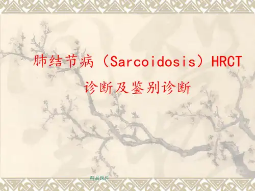 结节病HRCT诊断及鉴别诊断