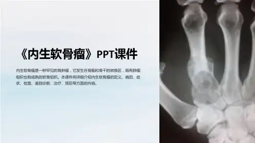 《内生软骨瘤》课件