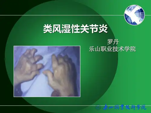 类风湿关节炎