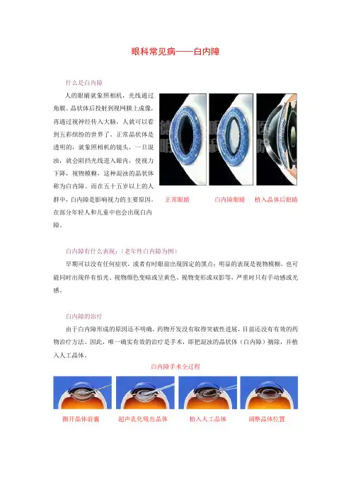 眼科常见病——白内障
