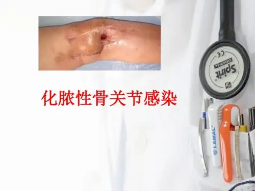 化脓性关节炎查房 ppt课件