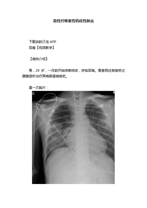 急性纤维素性机化性肺炎