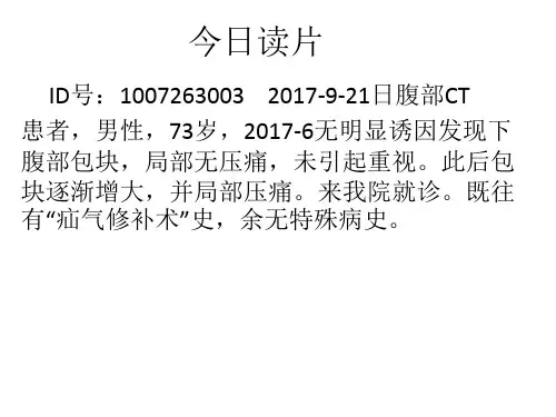 腹膜后脂肪肉瘤影像学表现与鉴别诊断ppt课件