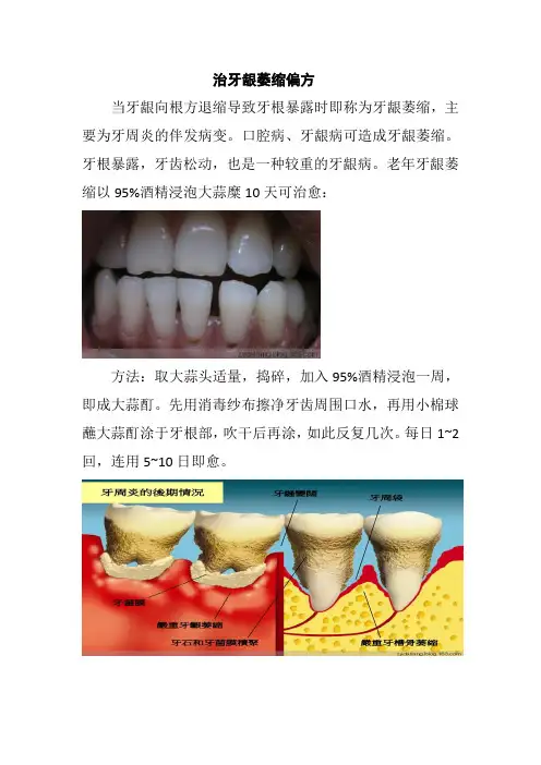 治牙龈萎缩偏方