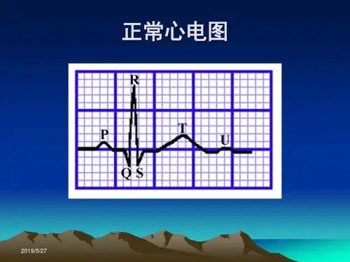 急性冠状动脉综合征急诊处理