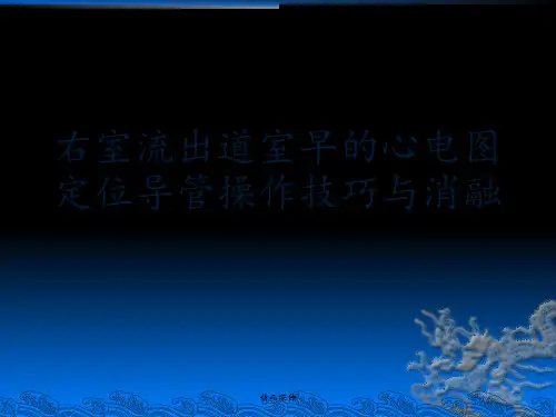右室流出道室早的心电图定位和消融