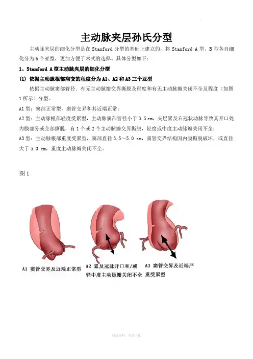 夹层分型及治疗方式