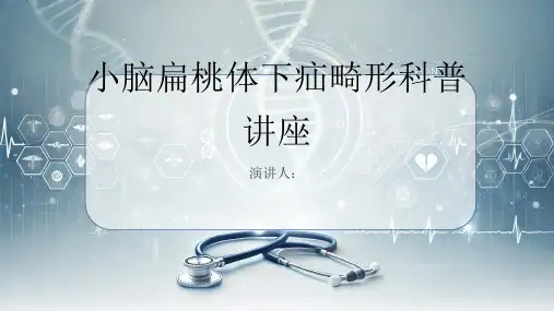 小脑扁桃体下疝畸形科普讲座PPT