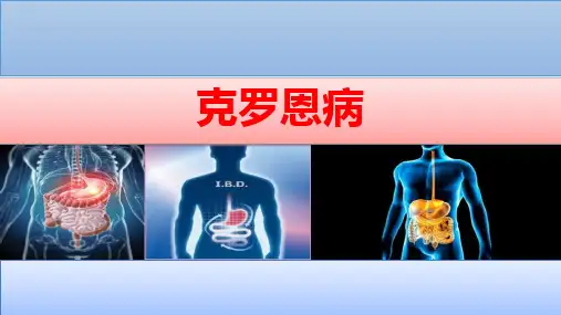 克罗恩病IBD