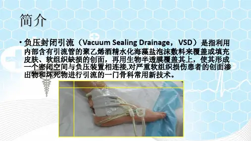 vsd负压引流术培训课件
