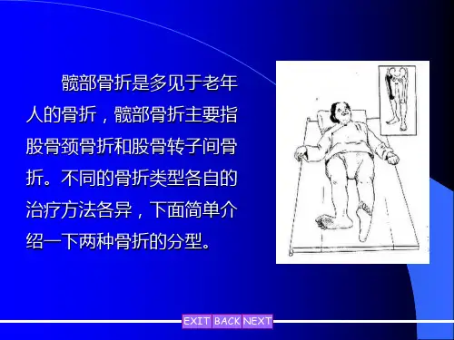 髋部骨折的分型