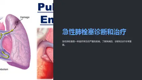 急性肺栓塞诊断和治疗