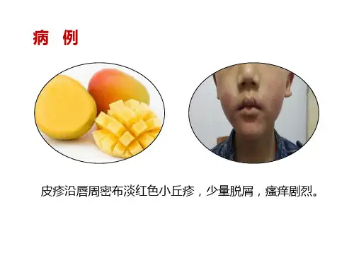 3616.5IV型超敏反应医学免疫学
