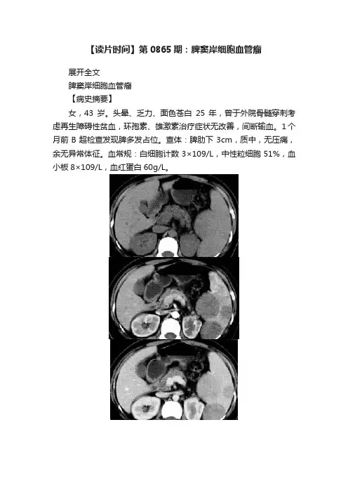【读片时间】第0865期：脾窦岸细胞血管瘤