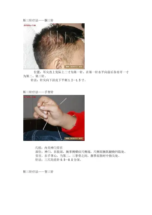 靳三针疗法