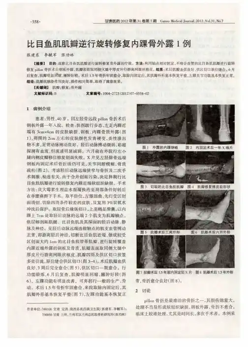 比目鱼肌肌瓣逆行旋转修复内踝骨外露1例
