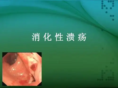 消化性溃疡