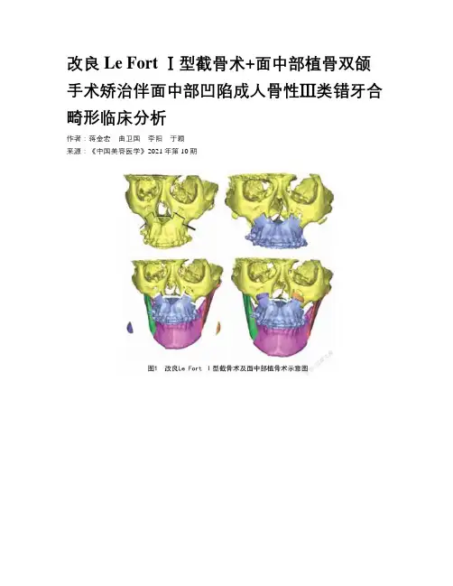 改良Le Fort Ⅰ型截骨术+面中部植骨双颌手术矫治伴面中部凹陷成人骨性Ⅲ类错牙合畸形临床分析