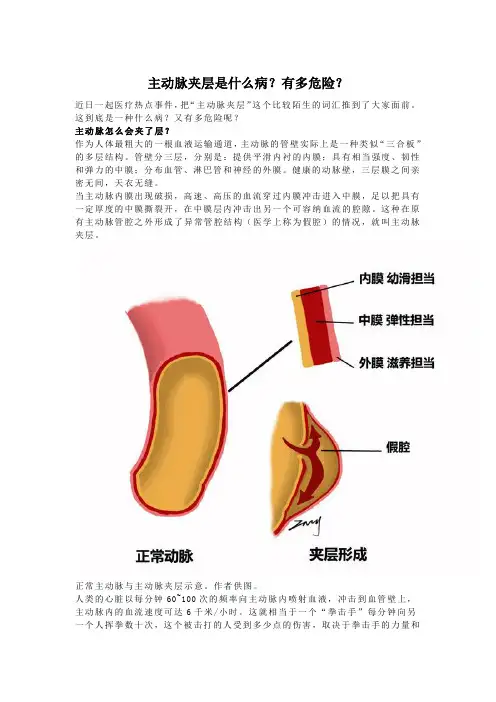 主动脉夹层是什么病有多危险