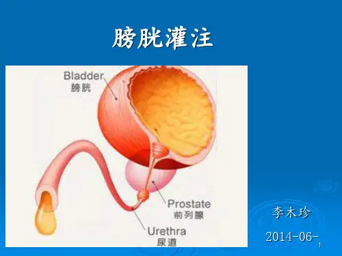 膀胱灌注术ppt课件