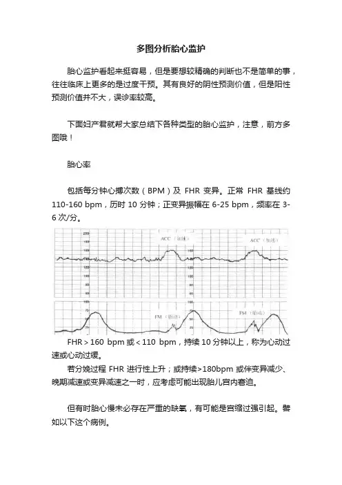 多图分析胎心监护