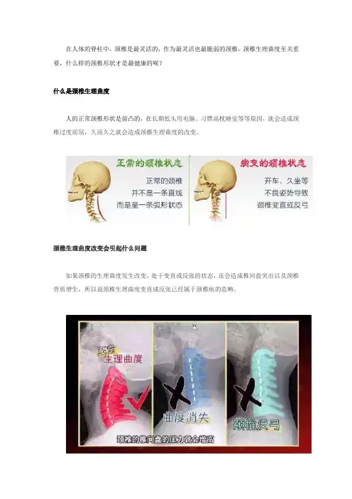 颈椎生理曲度变直是什么意思,问题严重吗