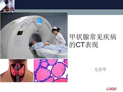 甲状腺常见疾病的CT表现