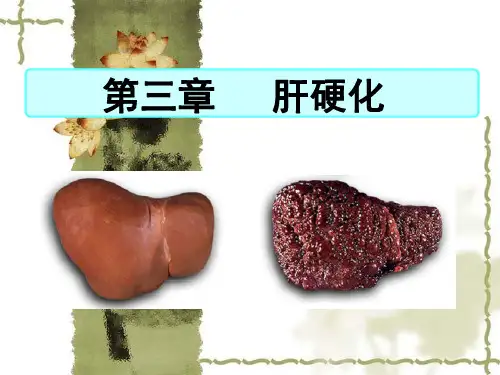 肝硬化