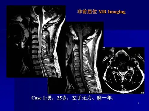 平山病PPT课件