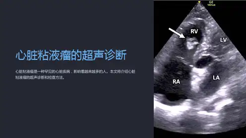 心脏粘液瘤的超声诊断