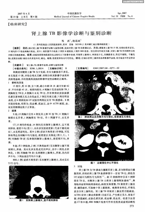 肾上腺TB影像学诊断与鉴别诊断