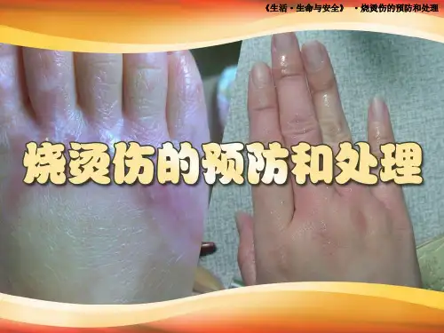 烧烫伤的预防和处理PPT课件
