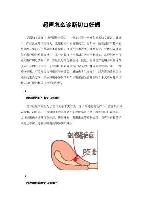 超声怎么诊断切口妊娠
