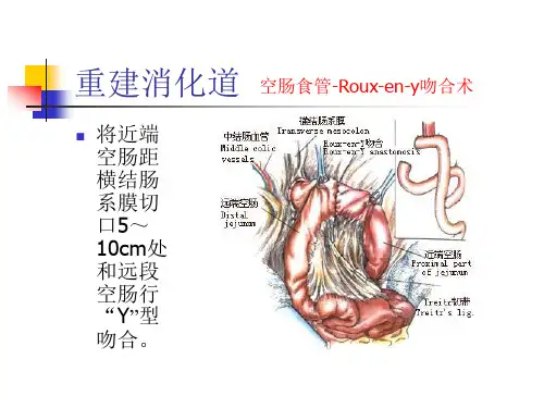 图解全胃切除手术PPT课件