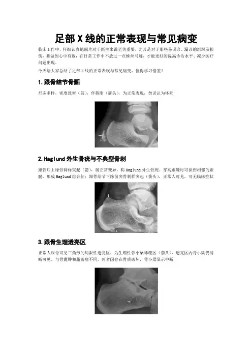 足部X线的正常表现与常见病变