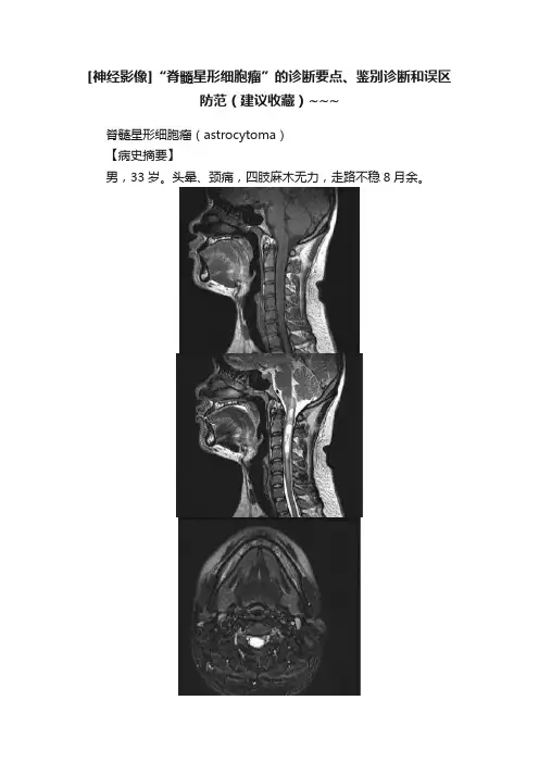 [神经影像]“脊髓星形细胞瘤”的诊断要点、鉴别诊断和误区防范（建议收藏）~~~
