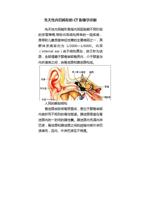 先天性内耳畸形的CT影像学诊断