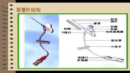 小儿静脉留置针穿刺技巧
