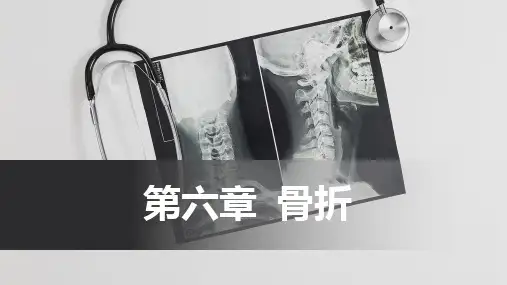 骨折-骨折概述(中医骨伤科学十三五教材)可修改文字