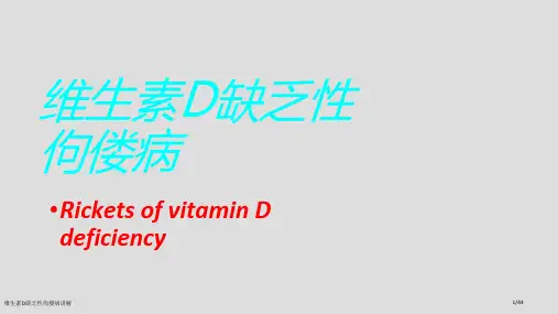 维生素D缺乏性佝偻病讲解